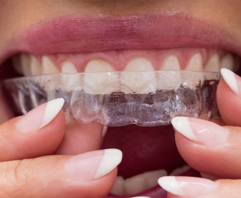 Invisalign